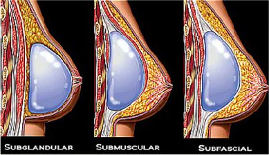 Subfacial implants