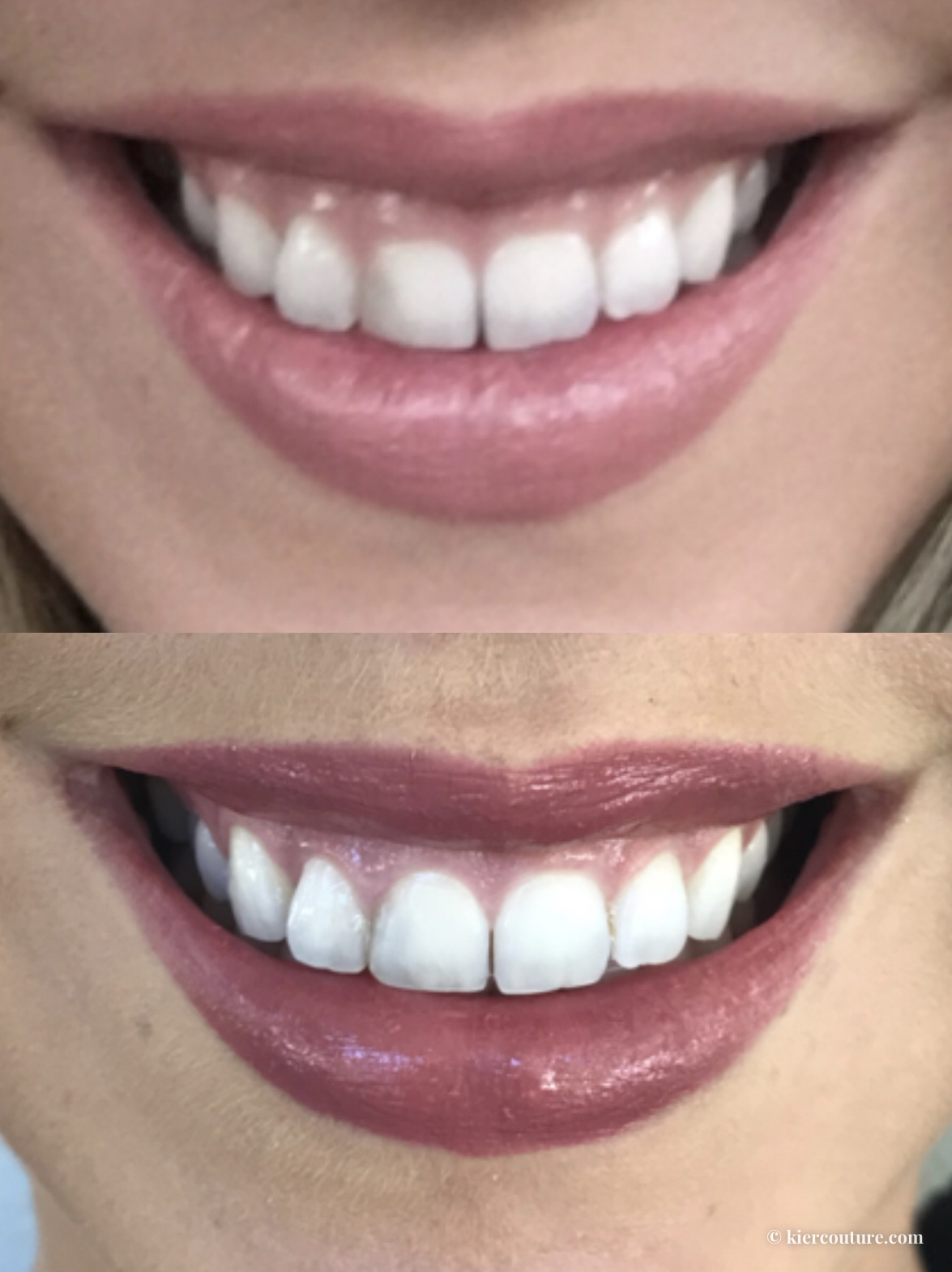 Laser Crown Lengthening